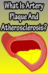 What Is Artery Plaque And Atherosclerosis?
