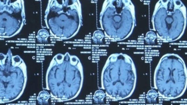 Watch Alzheimer's Project: Momentum in Sci 1 Online