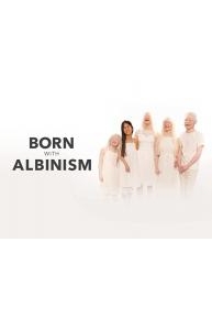 Born With Albinism